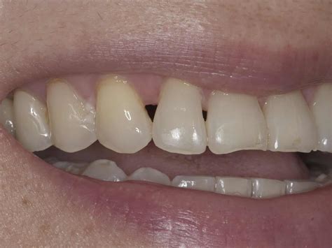 Triangle dentistry - Triangle Dentistry offers affordable and quality dental services for over 50 years. Whether you need a cleaning, a crown, a veneer, or Invisalign, you can book an appointment …